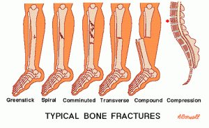 fracture - american football injuries