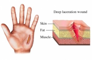 lacerations - american football injuries