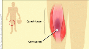 muscle contusion - american football injuries