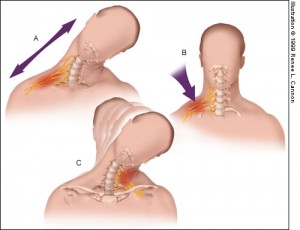 nerve injury - american football injuries