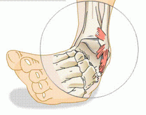 american football injuries - spraind and strains